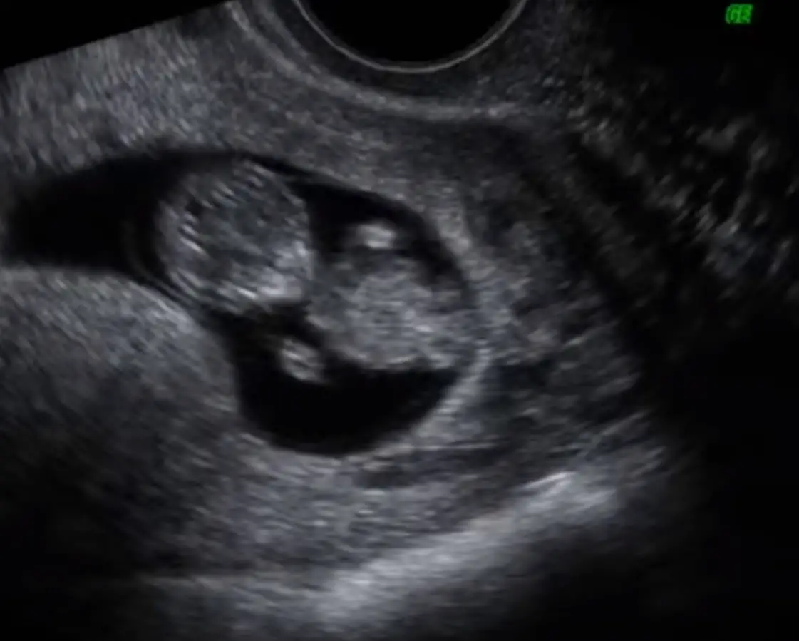 10 semanas de embarazo: Tu bebé comienza a moverse - Alas 10 Semanas De Embarazo Ya Se Mueve El Bebe